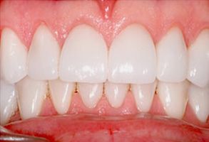 Glowing Smile Dental Studio | Dental Bridges, Dentures and Ceramic Crowns