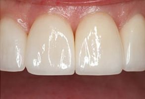 Glowing Smile Dental Studio | Implant Restorations, Ceramic Crowns and Dentures