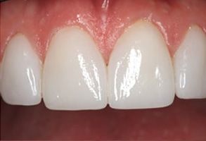 Glowing Smile Dental Studio | All-on-6 reg , Implant Restorations and Cosmetic Dentistry